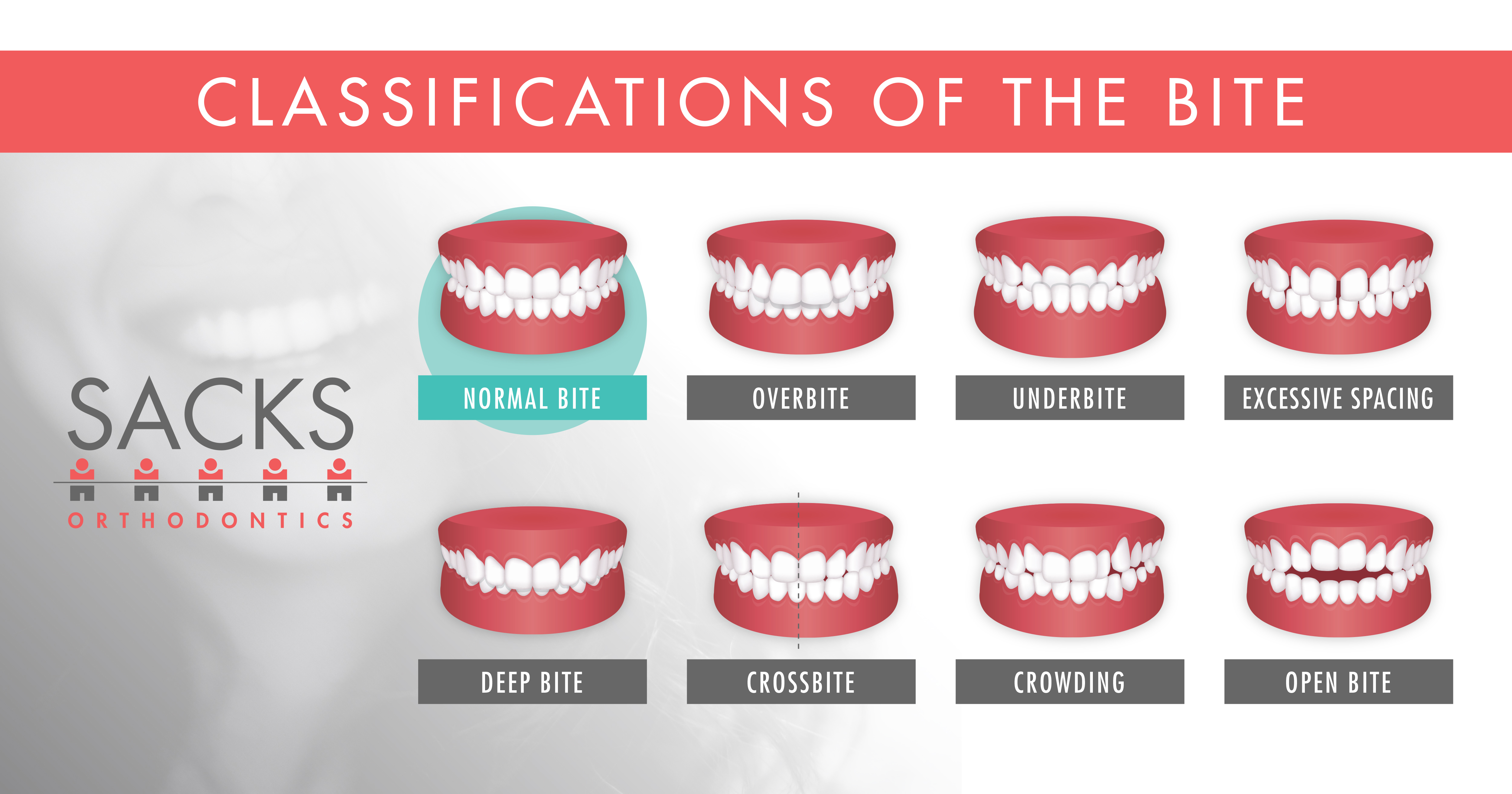 Does Bite Classification Matter for My Braces Treatment?